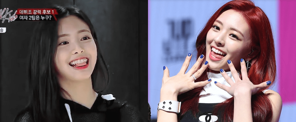 잇지 유나 치아교정