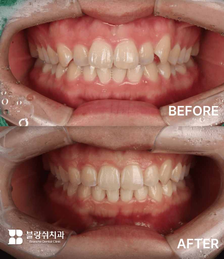 인비절라인 덧니 교정 장치 착용 전후의 치열 개선 사례