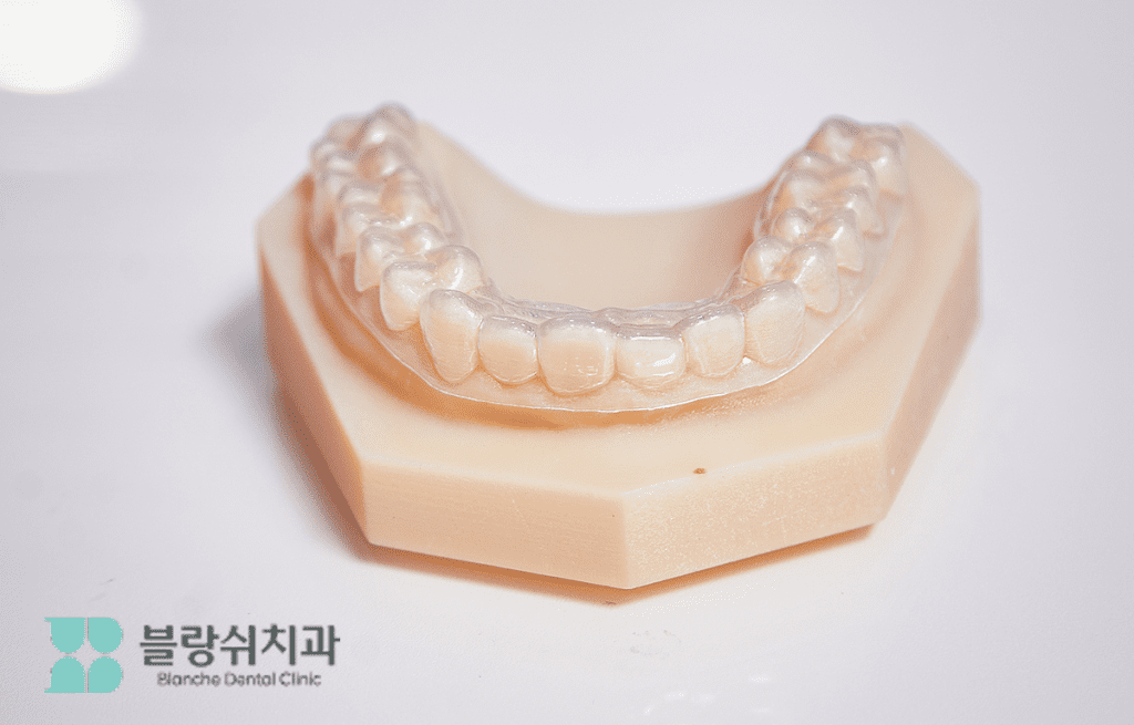 30대 40대 치아교정용 인비절라인 투명 장치가 장착된 치아 모형
