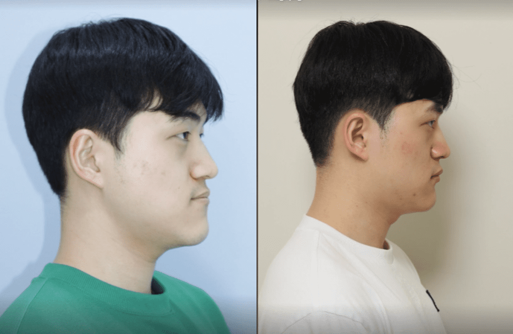 블랑쉬치과 주걱텩 교정 치료 사례