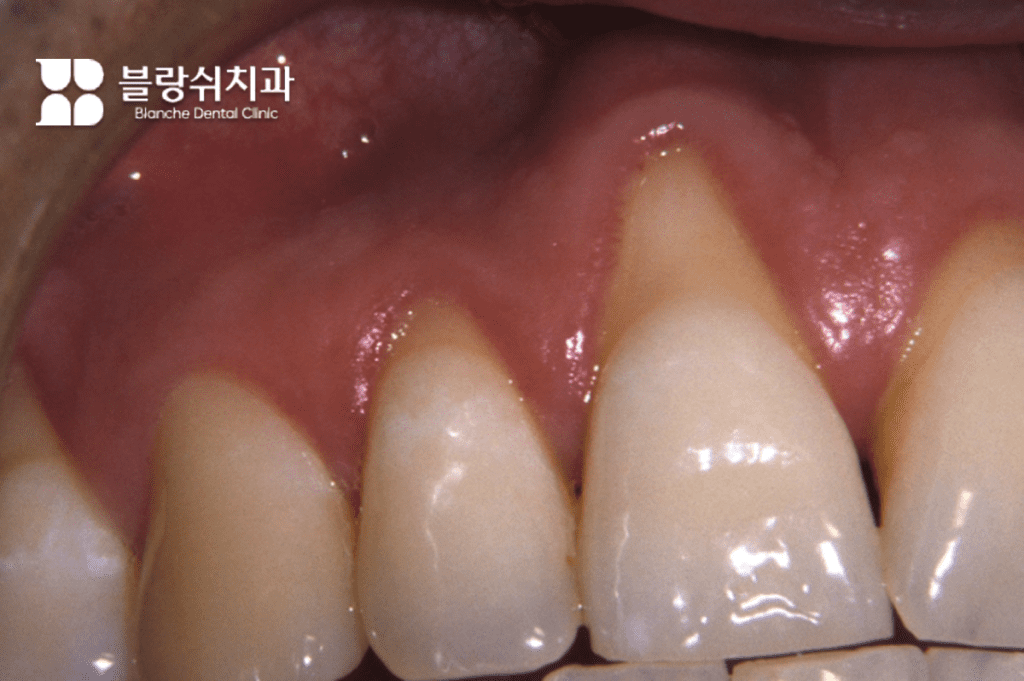 30대 40대 치아교정 부작용인 잇몸 퇴축으로 치아 뿌리가 노출된 상태