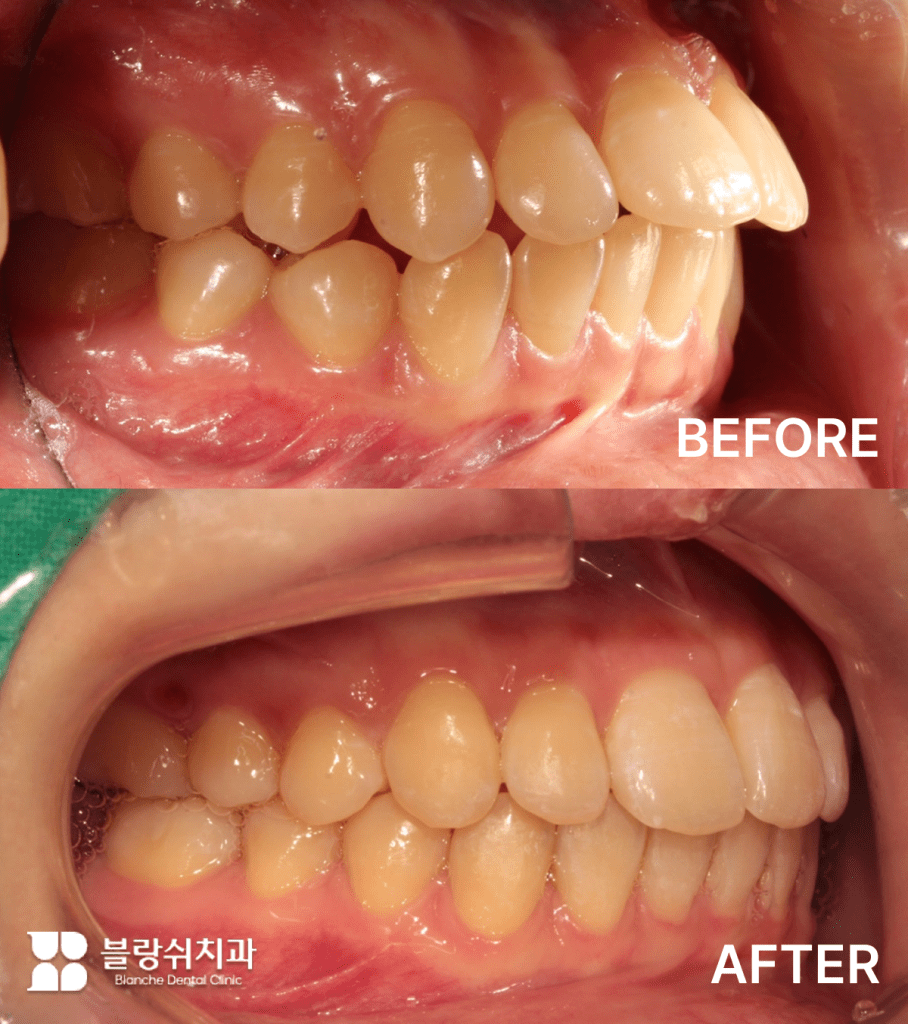 클리피씨 시술 후기 - 10대 청소년 환자