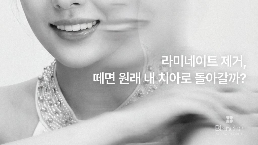 라미네이트 제거, 떼면 원래 내 치아로 돌아갈까?
