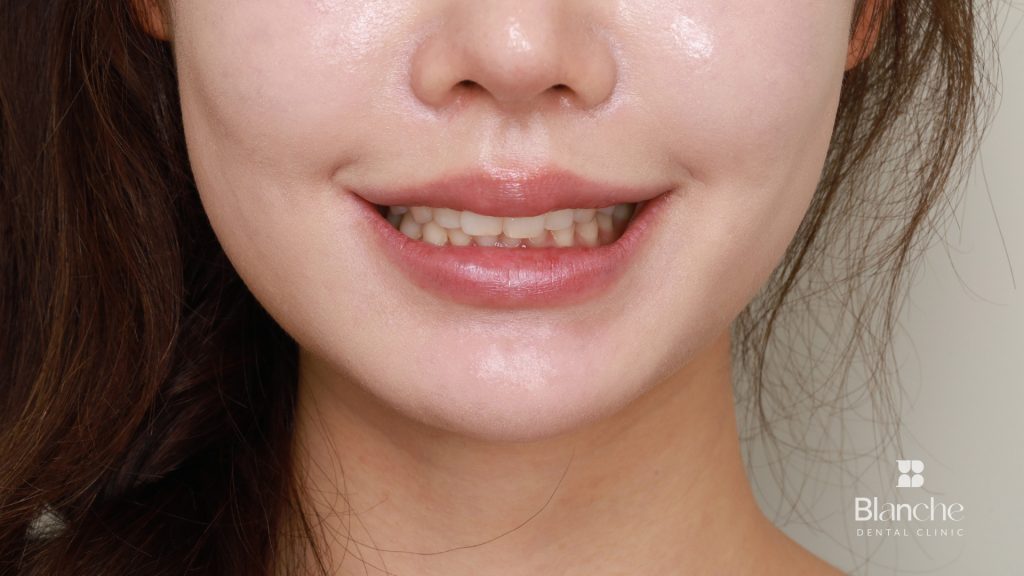 블랑쉬 라미네이트 환자 비포