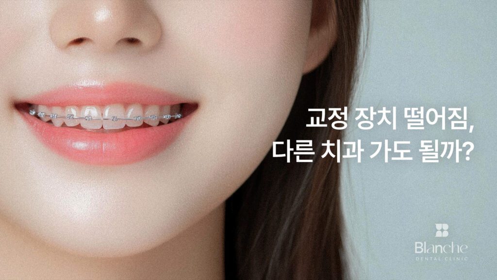 교정 장치 떨어짐, 다른 치과 가도 될까?