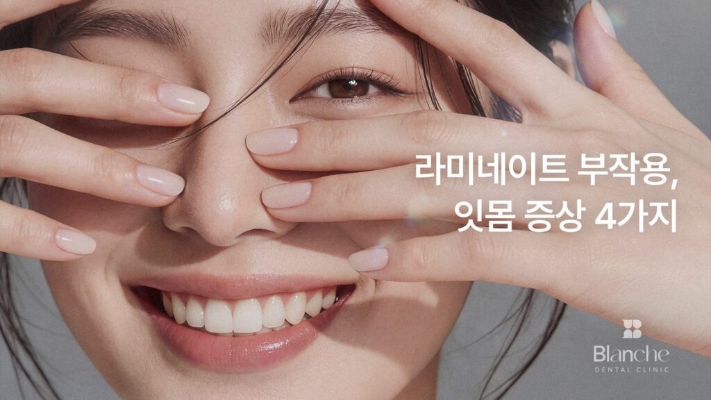 라미네이트 부작용 잇몸 증상 4가지