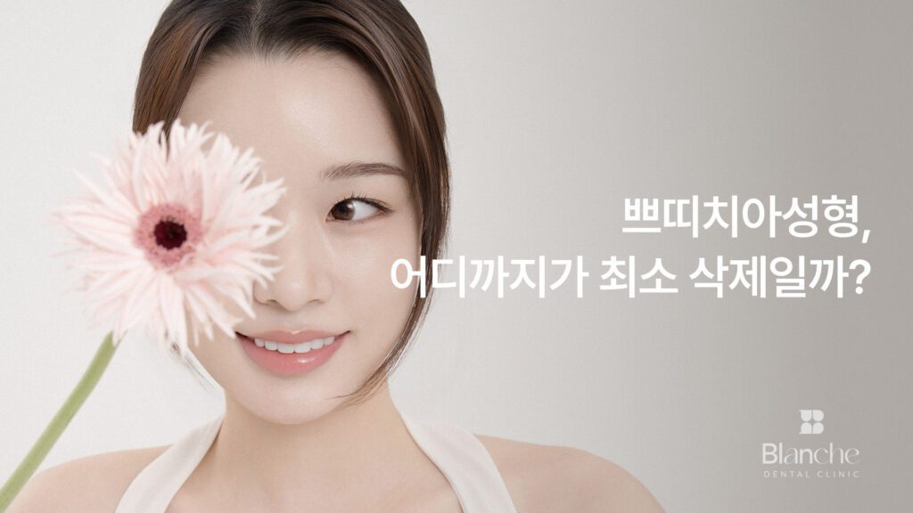 썸네일 - 쁘띠치아성형, 어디까지가 최소 삭제일까?