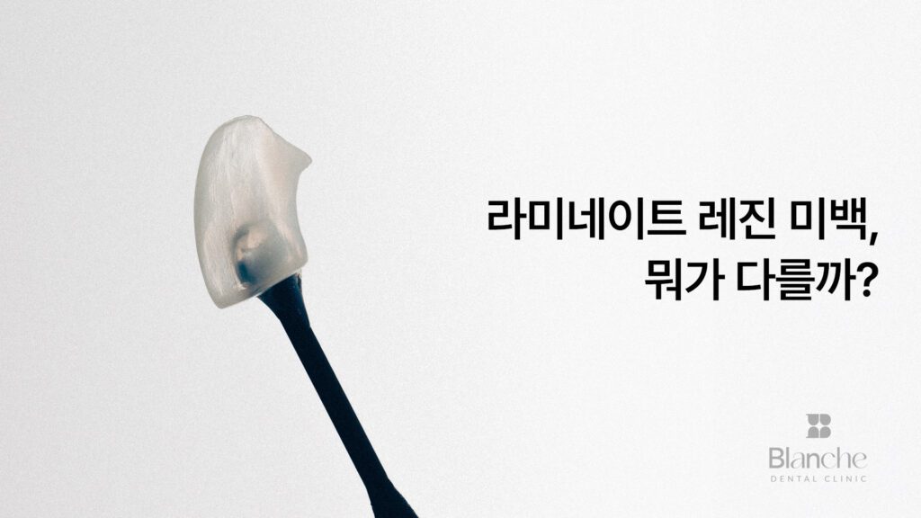 라미네이트 레진 미백, 뭐가 다를까? 목적별 선택 가이드