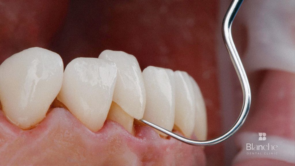 Does Removing Old Veneers Damage Your Teeth?