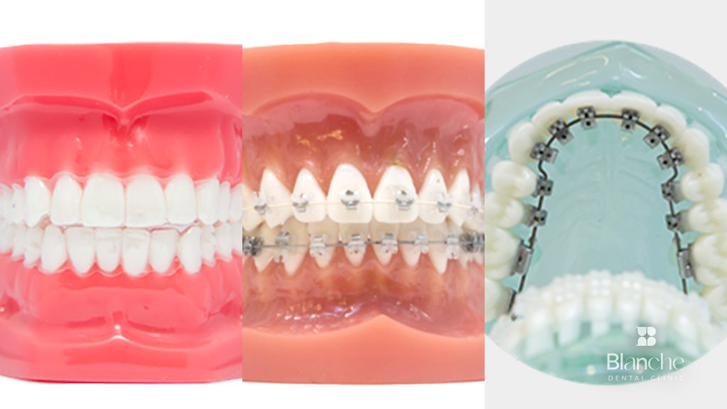 Invisalign vs. Braces in Korea