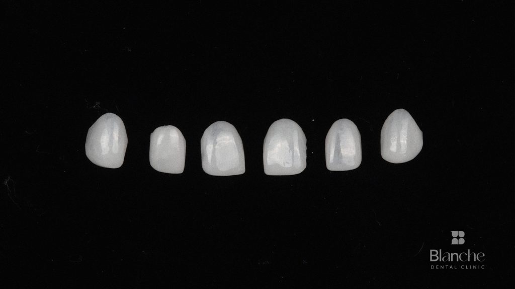 Veneer Replacement Cost in Korea