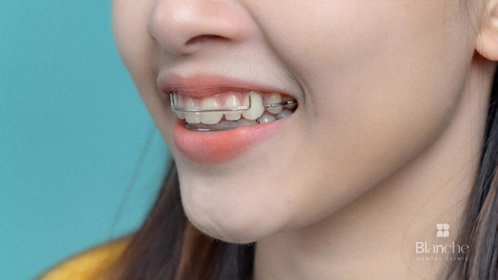 치아 유지장치