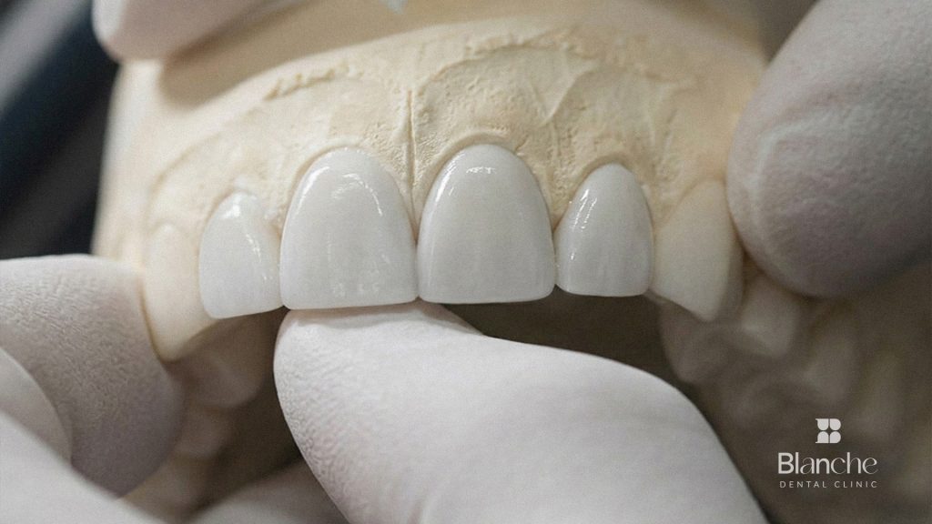 Same-Day Veneers: How Travelers Fit Treatment into One Trip