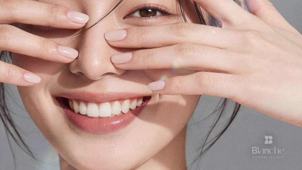 4 Questions to Ask Before Replacing Veneers