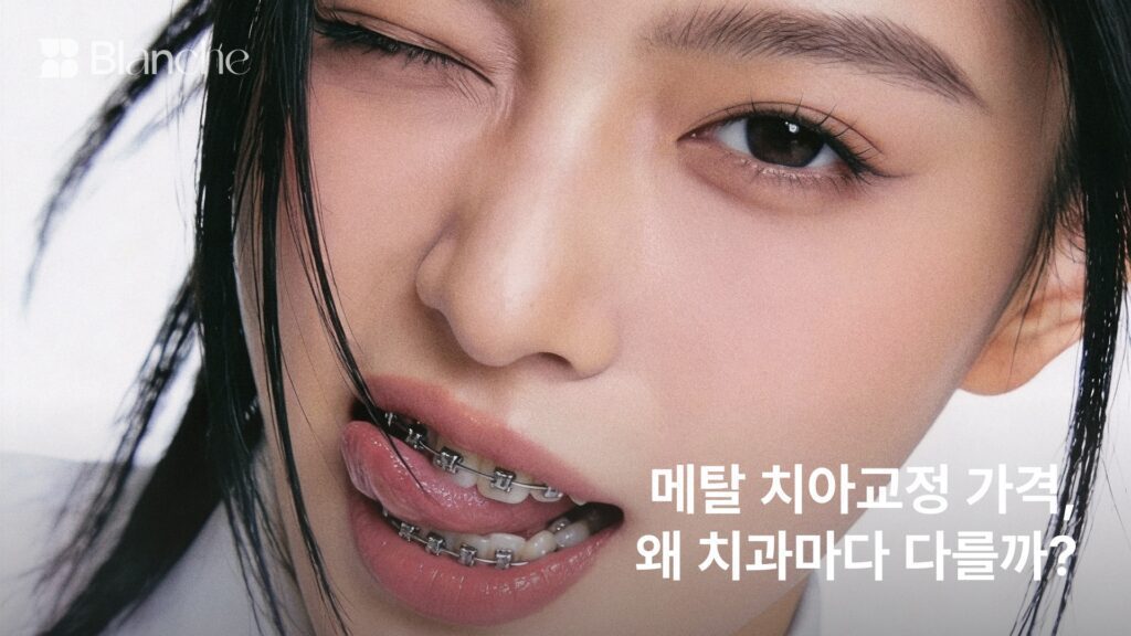 메탈 치아교정 가격, 왜 치과마다 다를까? 견적 확인 5가지
