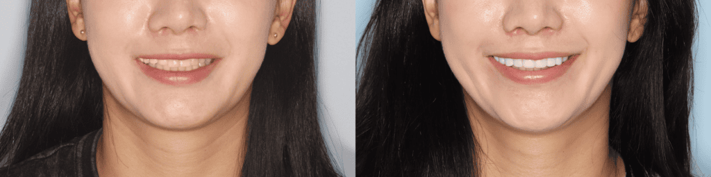 korean-veneers-before-and-after