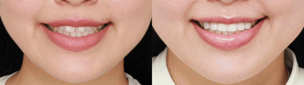 korean-veneers-before-and-after