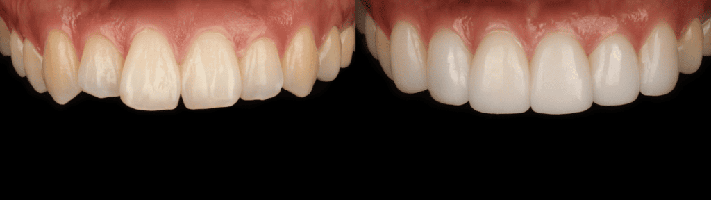 veneers-before-and-after