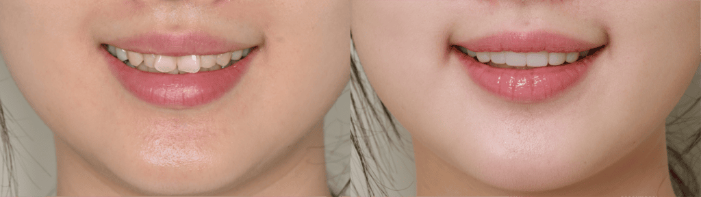 veneers-before-and-after