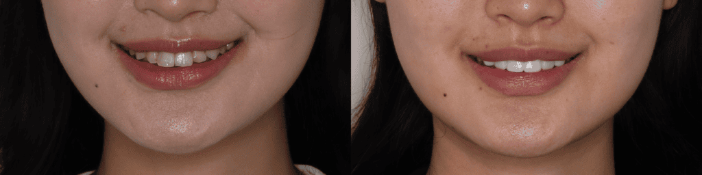 veneers-before-and-after