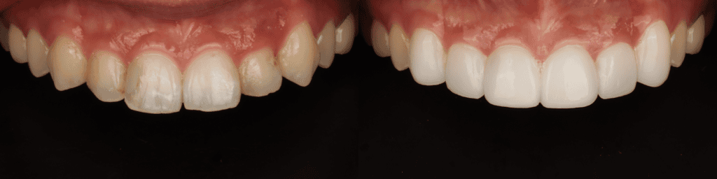 korean-veneers-before-and-after