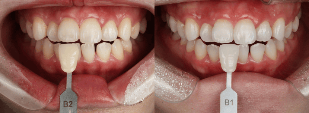 whitening-before-after