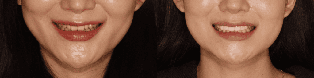 korean-veneers-before-and-after