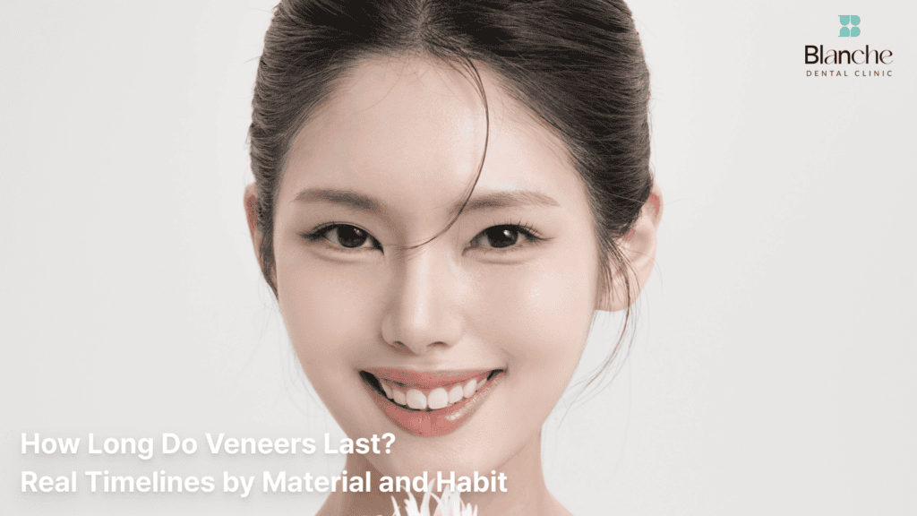 How Long Do Veneers Last? Real Timelines by Material and Habit