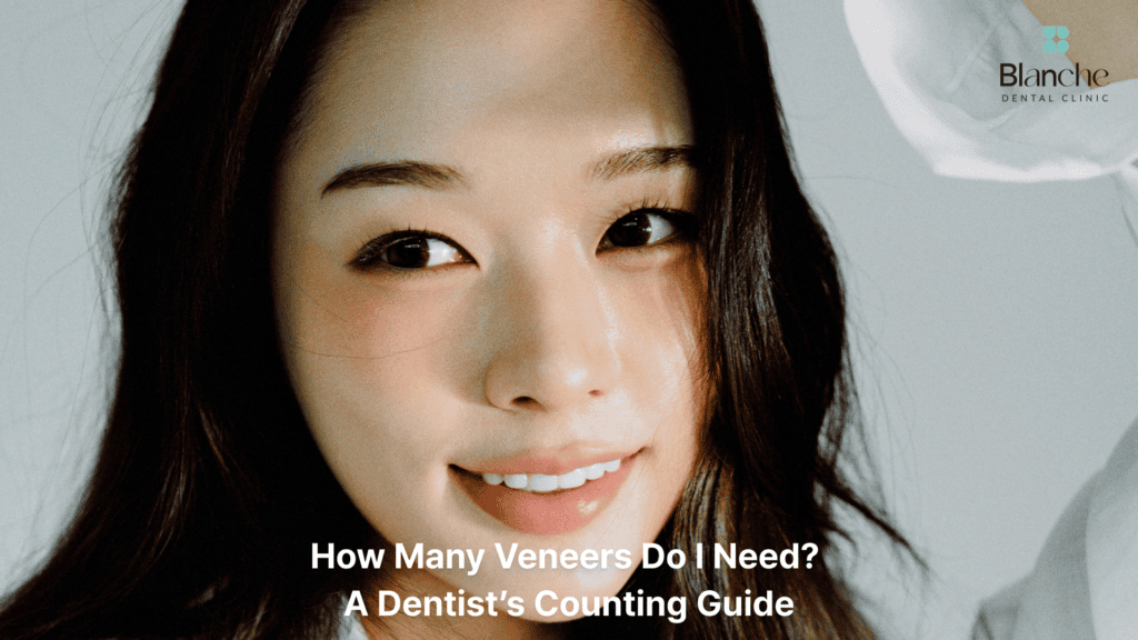 How Many Veneers Do I Need? A Dentist’s Counting Guide