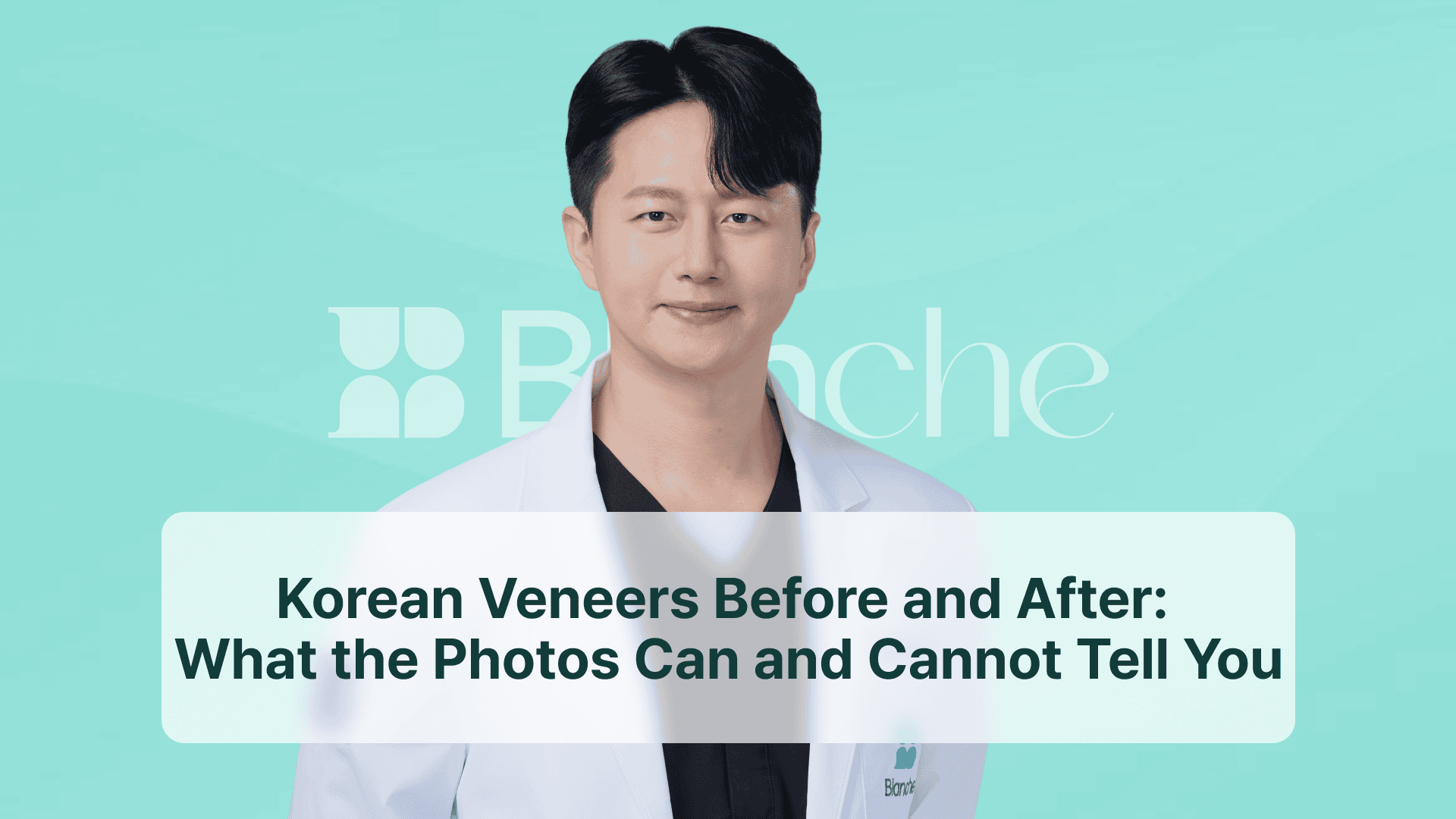 Korean Veneers Before and After: What the Photos Can and Cannot Tell You
