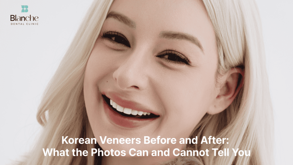 korean-veneers-before-and-after