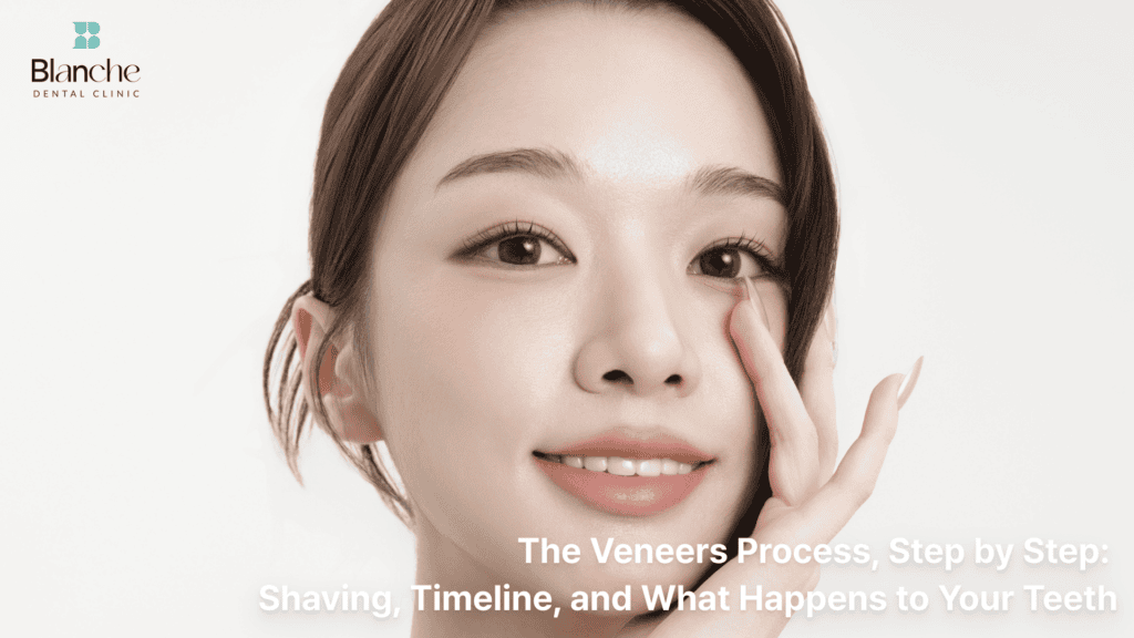 The Veneers Process, Step by Step: Shaving, Timeline, and What Happens to Your Teeth