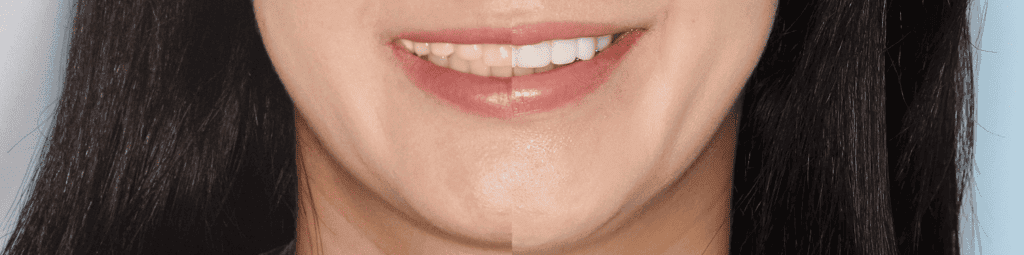 veneers-before-and-after