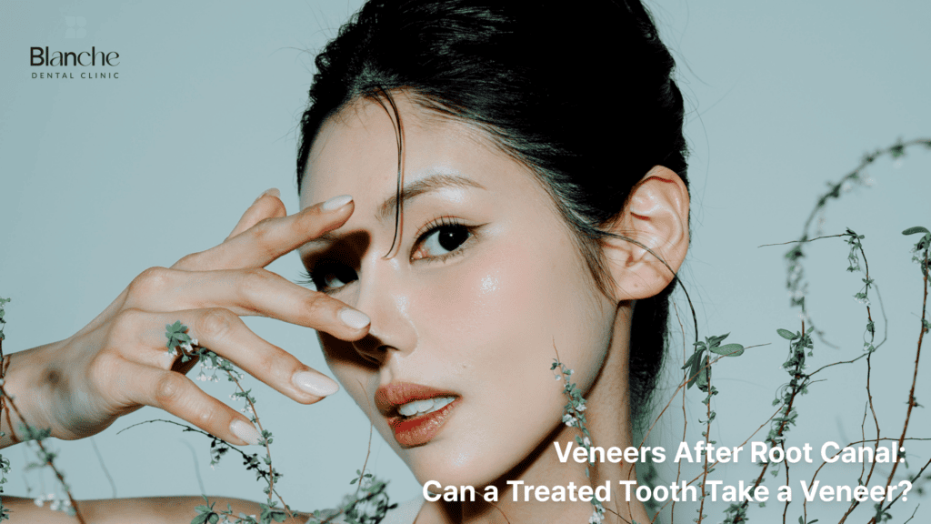 Veneers After Root Canal: Can a Treated Tooth Take a Veneer?